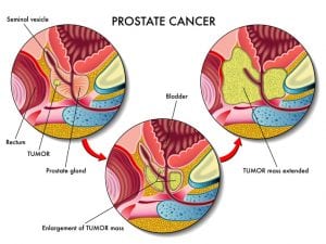 Low Dose Rate Brachytherapy for Prostate Cancer