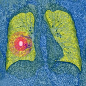 Lung Biopsy