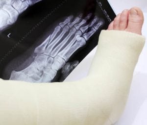 Open Reduction and Internal Fixation of a Foot Fracture