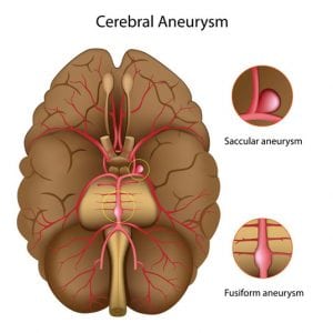 Cerebral Aneurysm Repair by Clipping