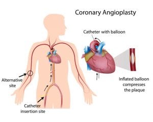 Coronary Angioplasty