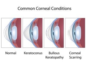 Descemet’s Stripping with Endothelial Keratoplasty