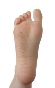 Electrodessication and Curettage for Plantar Warts