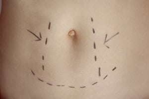 Endoscopically-Assisted Abdominoplasty