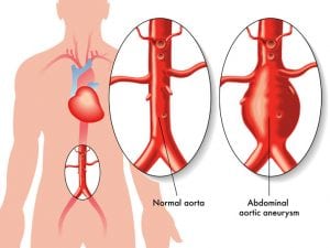 Endovascular Stent Grafting for Aortic Aneurysm