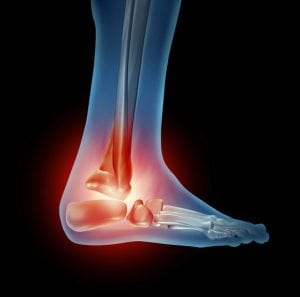 Foot Joint Replacement