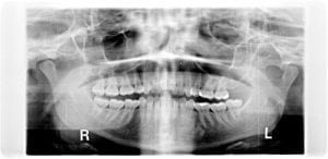 Temporomandibular Joint Discectomy