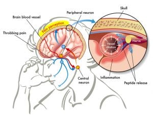 Trigger Point Surgery for Migraine