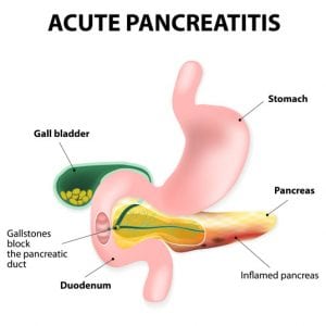 Laparoscopic Pancreatic Pseudocyst Drainage