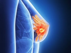 Intracavitary Brachytherapy for Breast Cancer