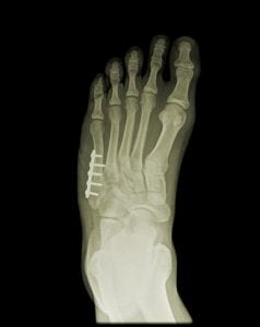 External Fixation of the Foot