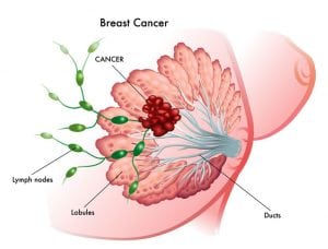 High Dose Rate Brachytherapy for Breast Cancer